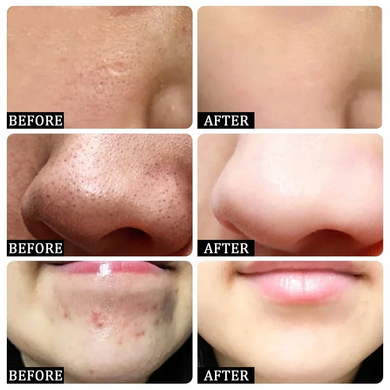 Salicylic Acid Pore Clearing C - Azelaic Acid Cream incelemesi ve fiyatı