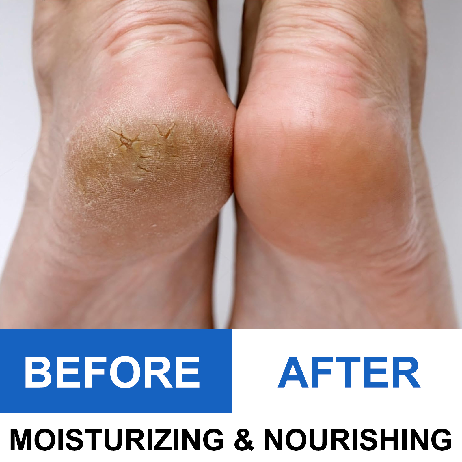 40% Urea Foot Cream Stick - Mo - Azelaic Acid Cream incelemesi ve fiyatı